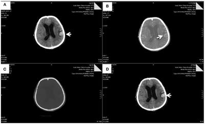 Elizabethkingia miricola Causes Intracranial Infection: A Case Study